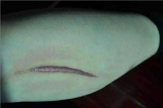 蜂王漿能幫助消炎愈合傷口嗎?蜂王漿對(duì)傷口有好處嗎?