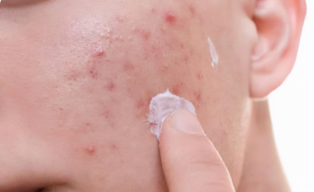 油性皮膚毛孔粗大怎么辦 面部皮膚油膩?學會這3個洗臉小技巧,讓你遠離“毛孔粗大”煩惱